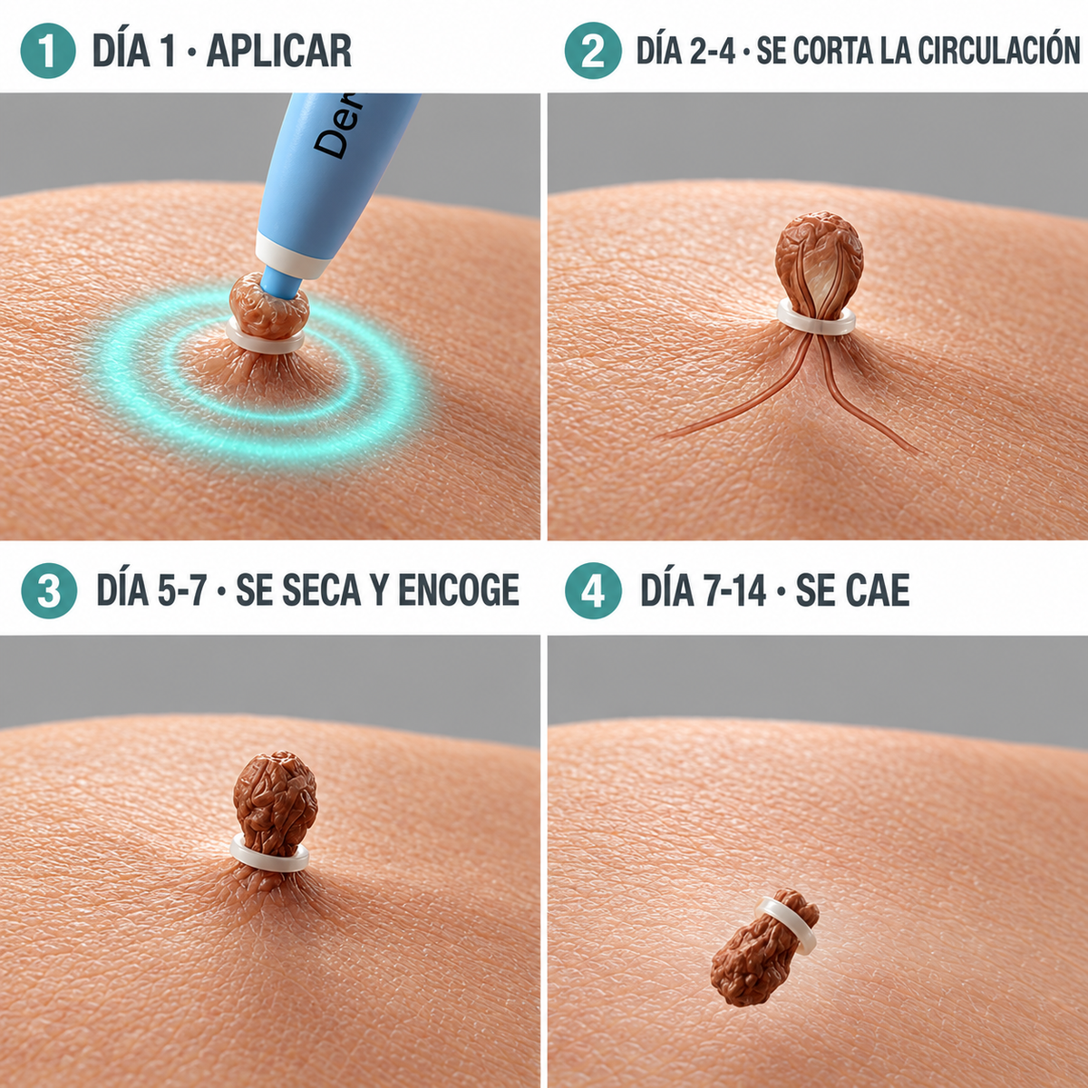 Removedor Indoloro de Fibromas
