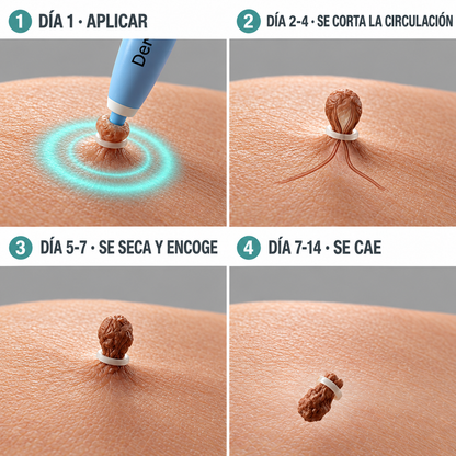 Removedor Indoloro de Fibromas