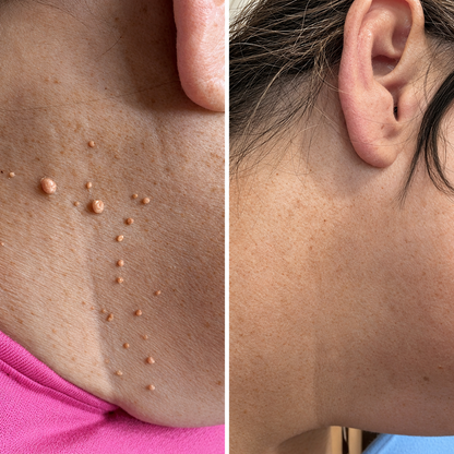 Removedor Indoloro de Fibromas